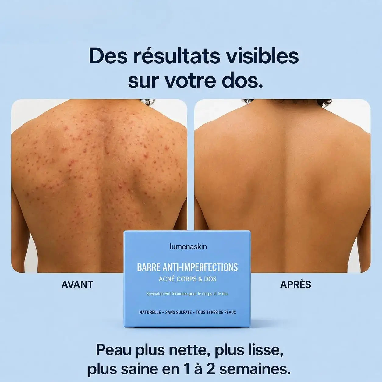 Barre anti-imperfections™